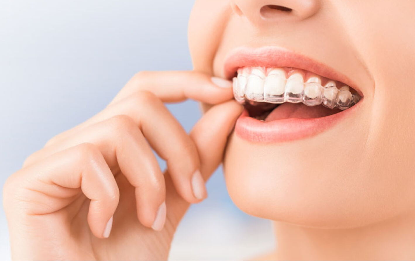 invisalign