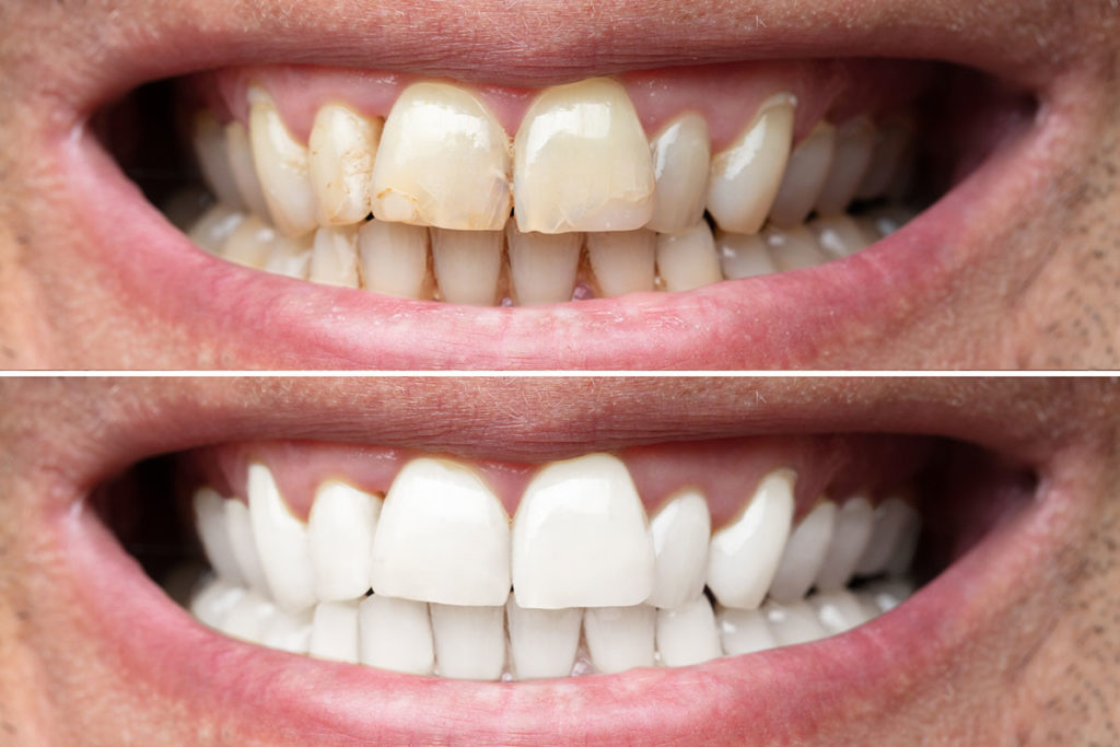 before and after teeth whitening