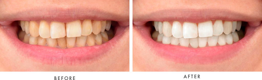 before and after teeth whitening