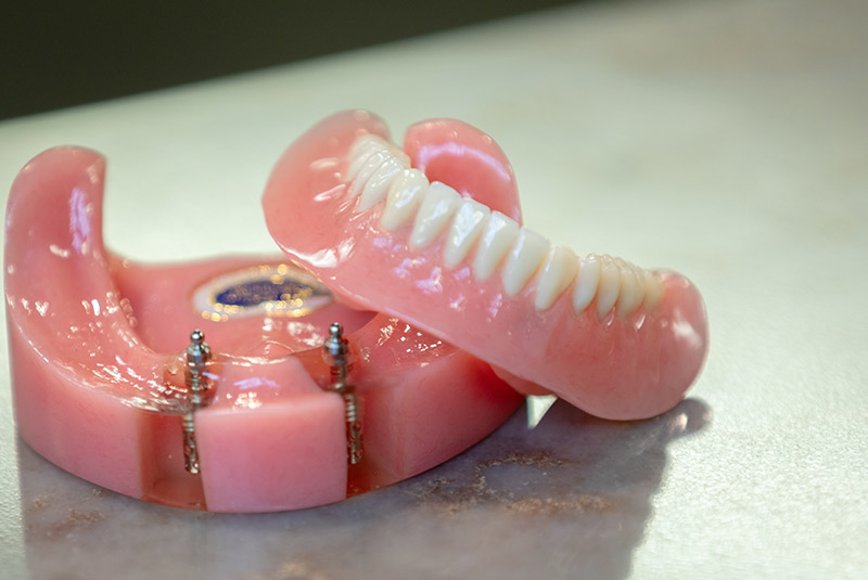 Implant supported dentures example model