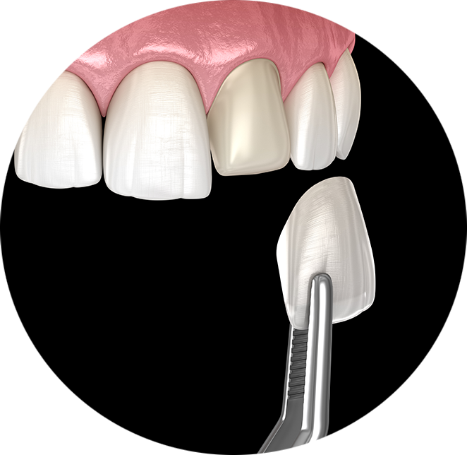 Veneers example model