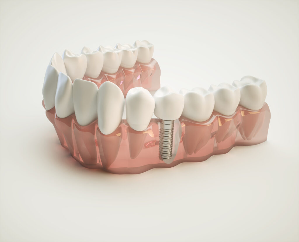 Dental Implant Example Model