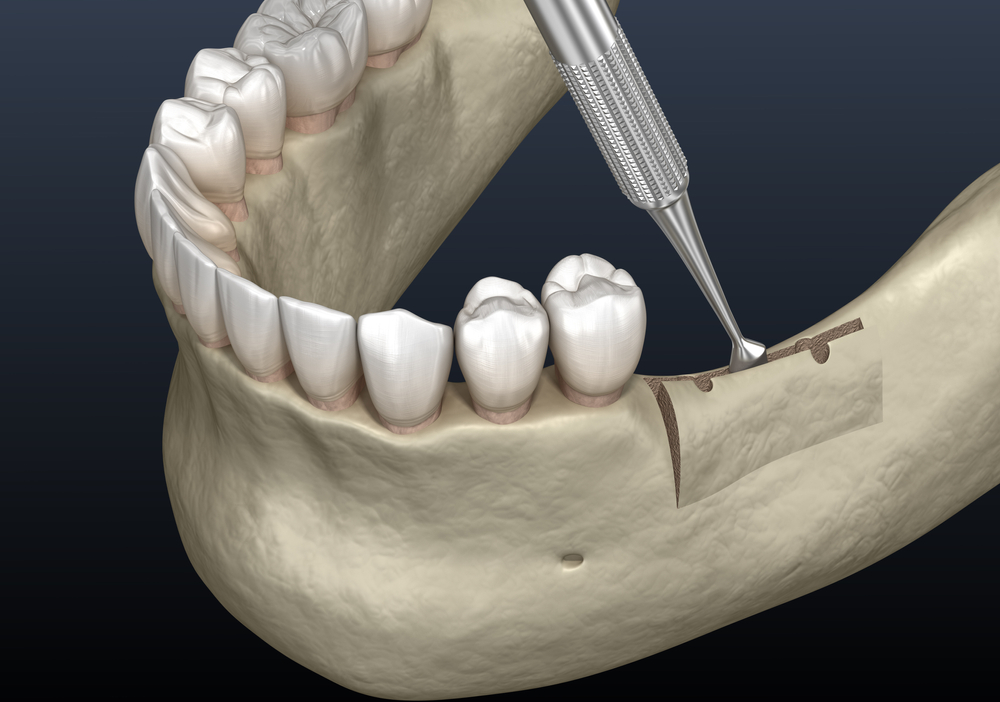 ridge augmentation for dental implants