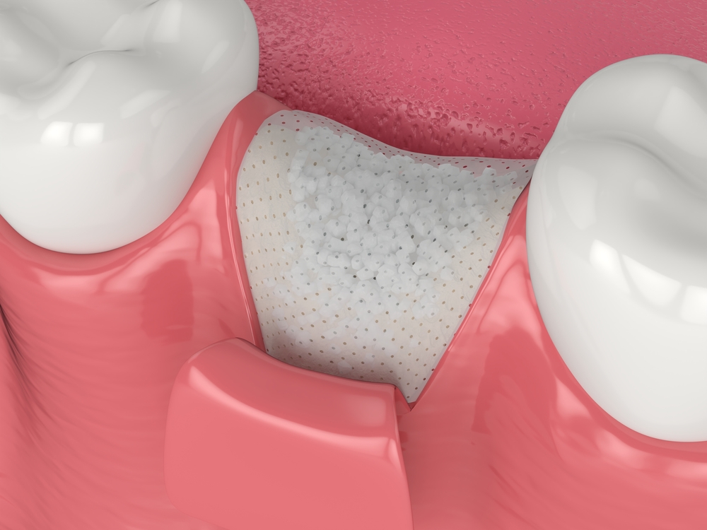 bone grafting for dental implants