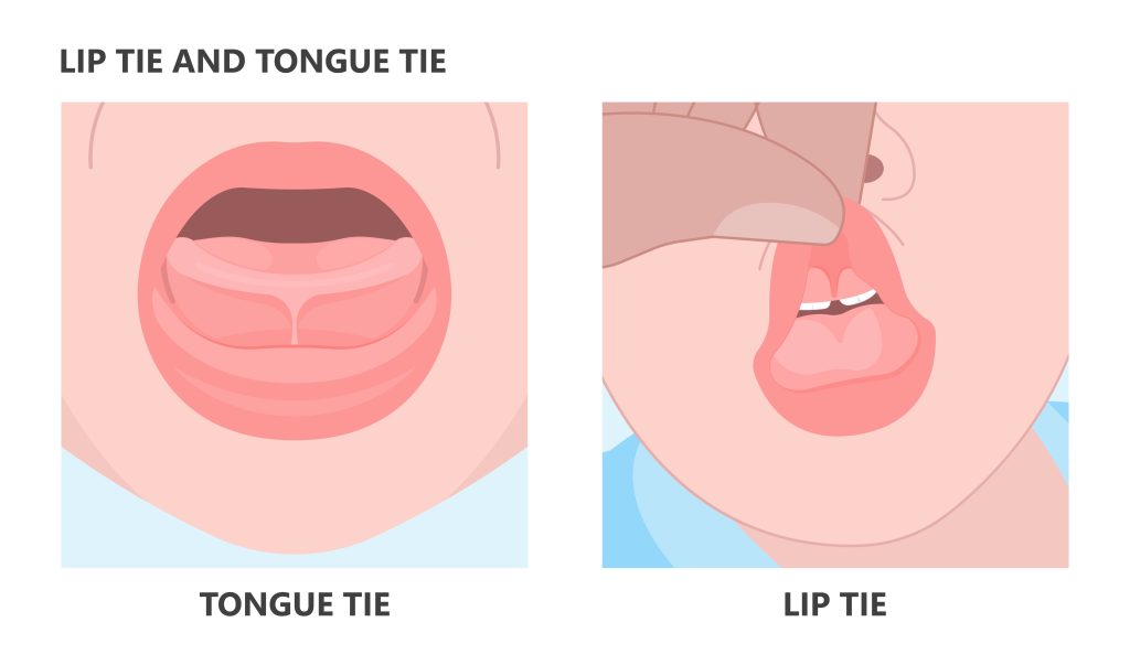 tongue and lip tie