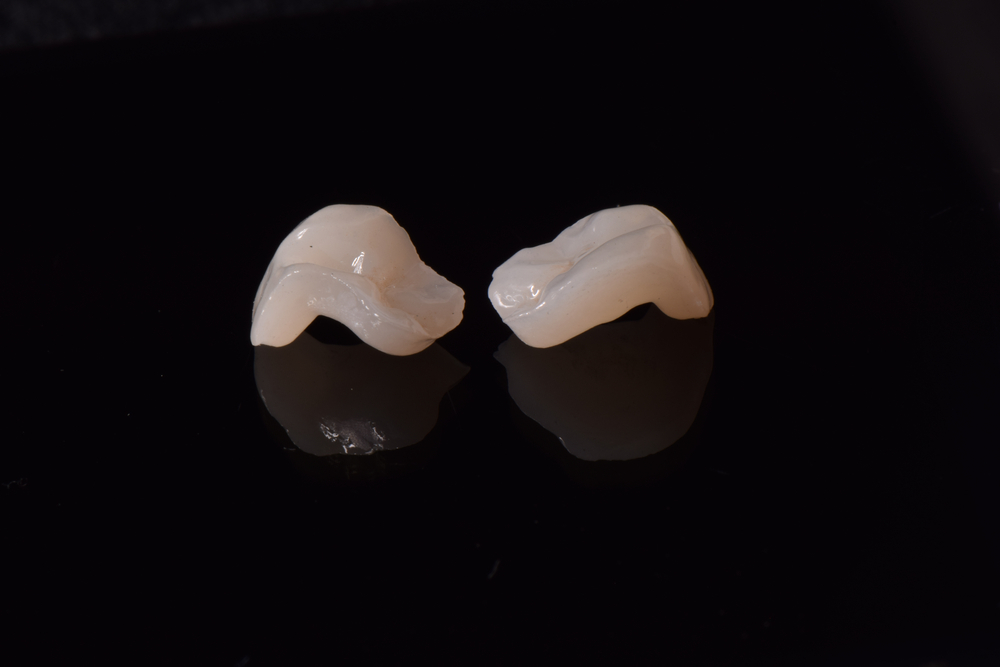 partial crowns