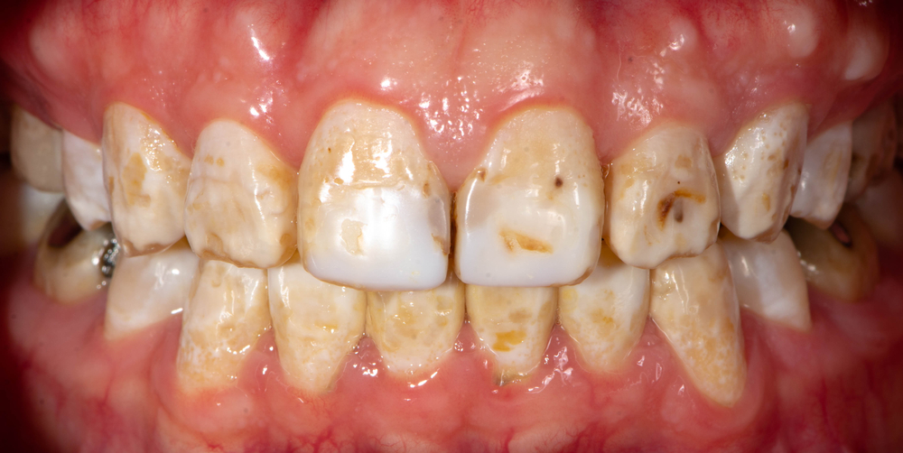 fluorosis