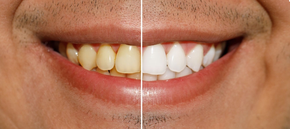 can yellow teeth turn white